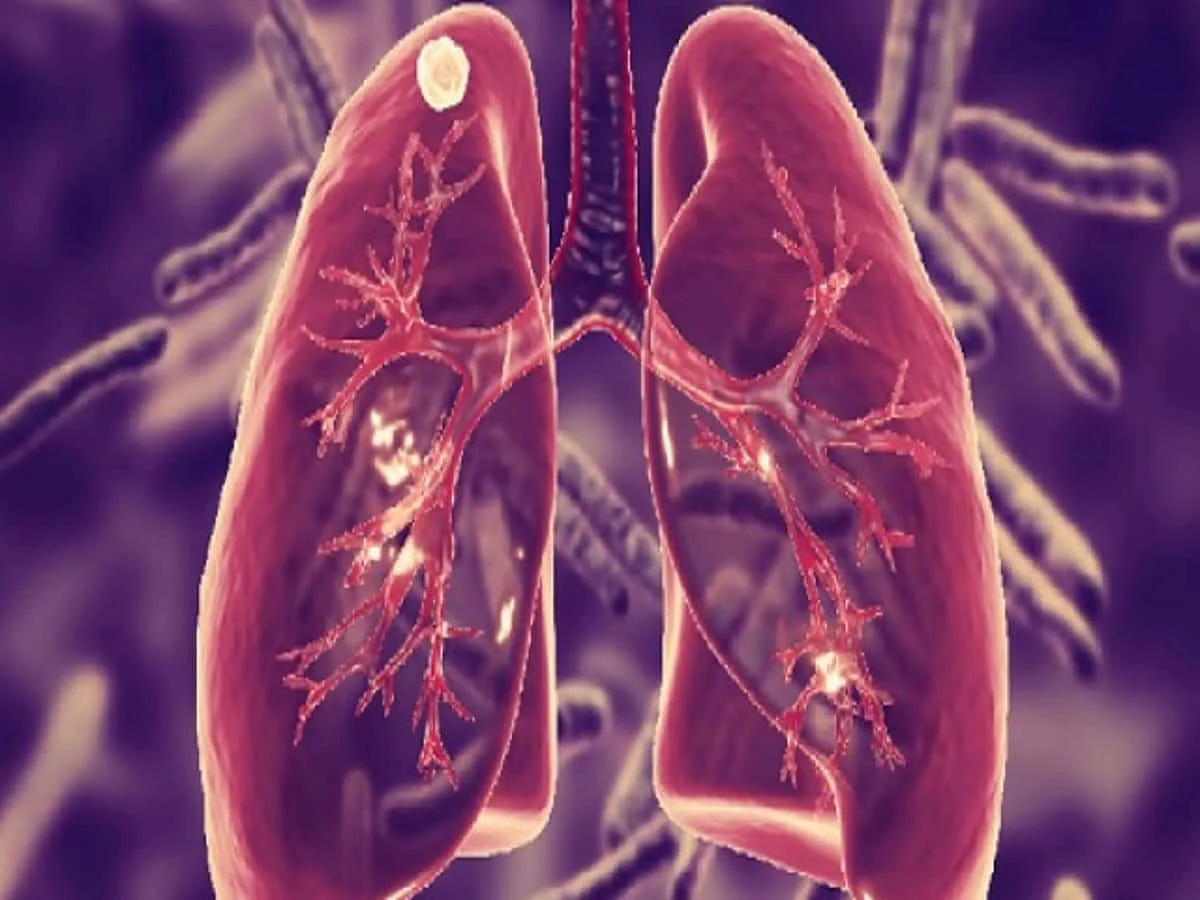 world tuberculosis day 2022 1648087266