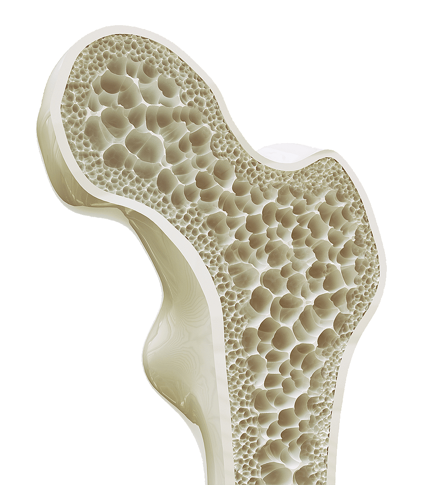 osteoporosis 2