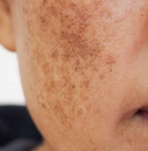 Dark Spot Treatments that Work Musely