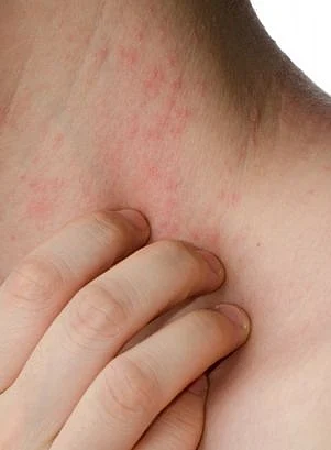 allergy