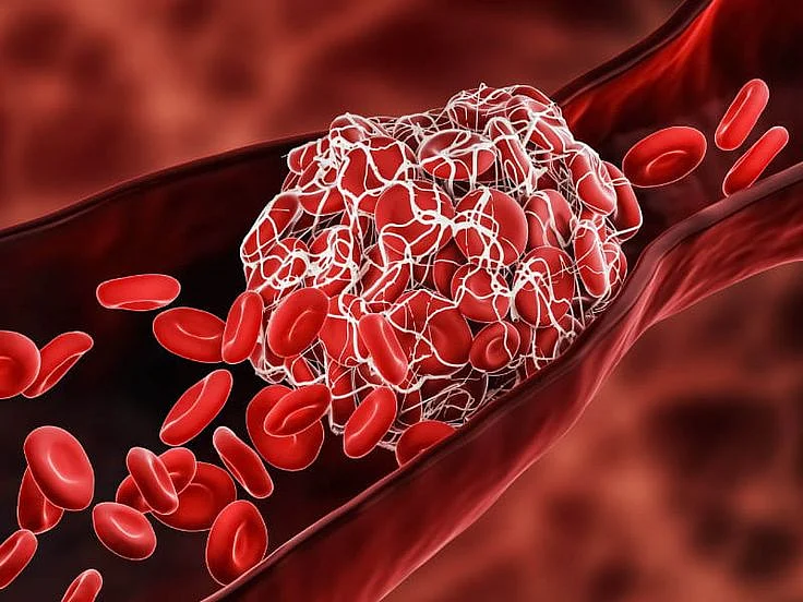Blood clot risk remains elevated nearly a year after COVID 19