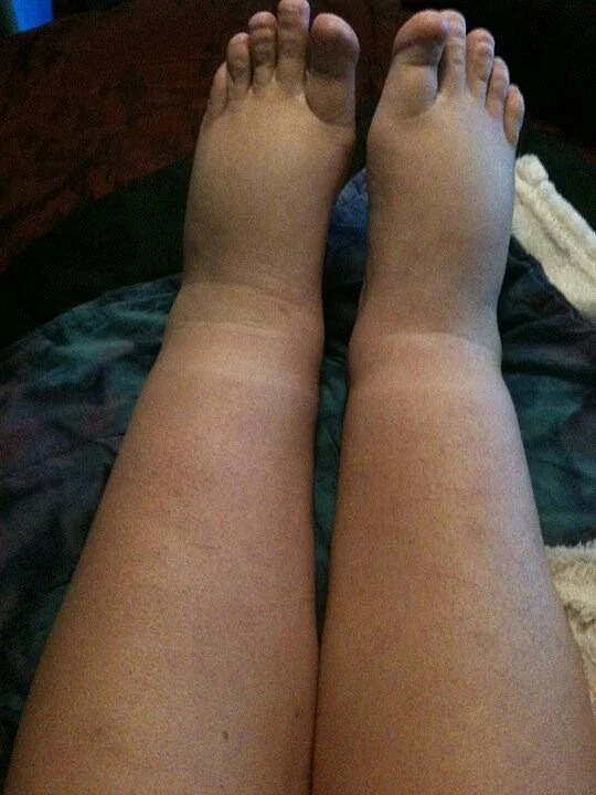 Icky swollen legs day 3