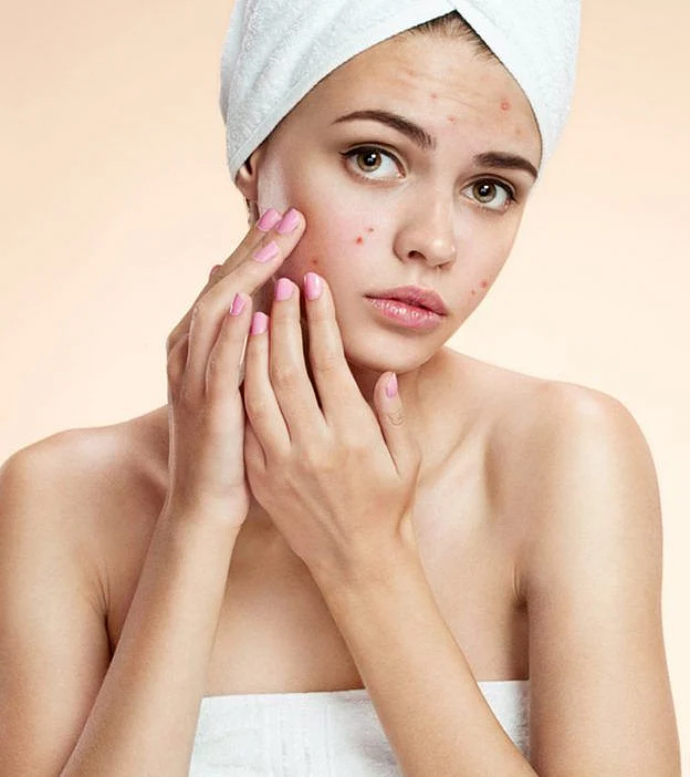 किशोरावस्था में कील मुंहासे होने के कारण इलाज व घरेलू नुस्खे Yuvavastha Me Pimple Kyu Hote Hai