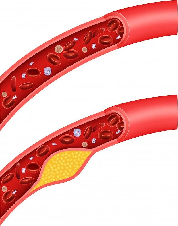 Premium Vector Illustration of cholesterol blocking artery