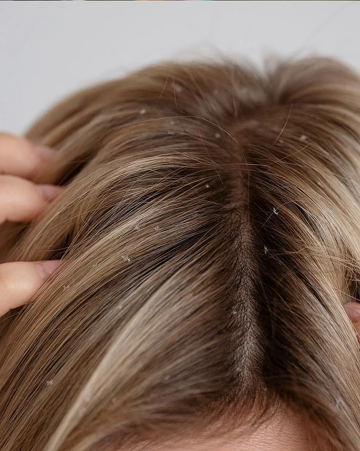 Some of the most common beliefs about dandruff…