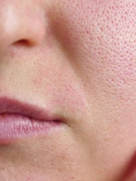 10 Simple Home Remedies To Get Rid Of Open Pores On Skin Beauty Epic