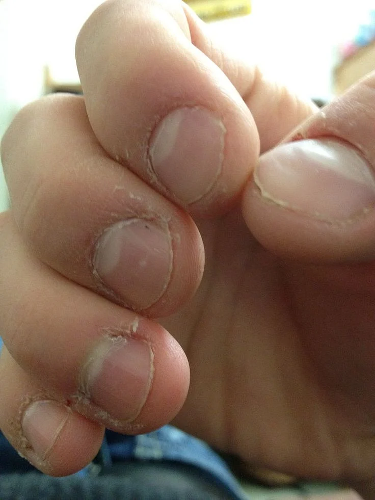 Stop Nail Biting Today