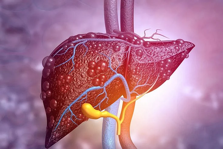 Fatty Liver Symptoms Key Signs To Recognize
