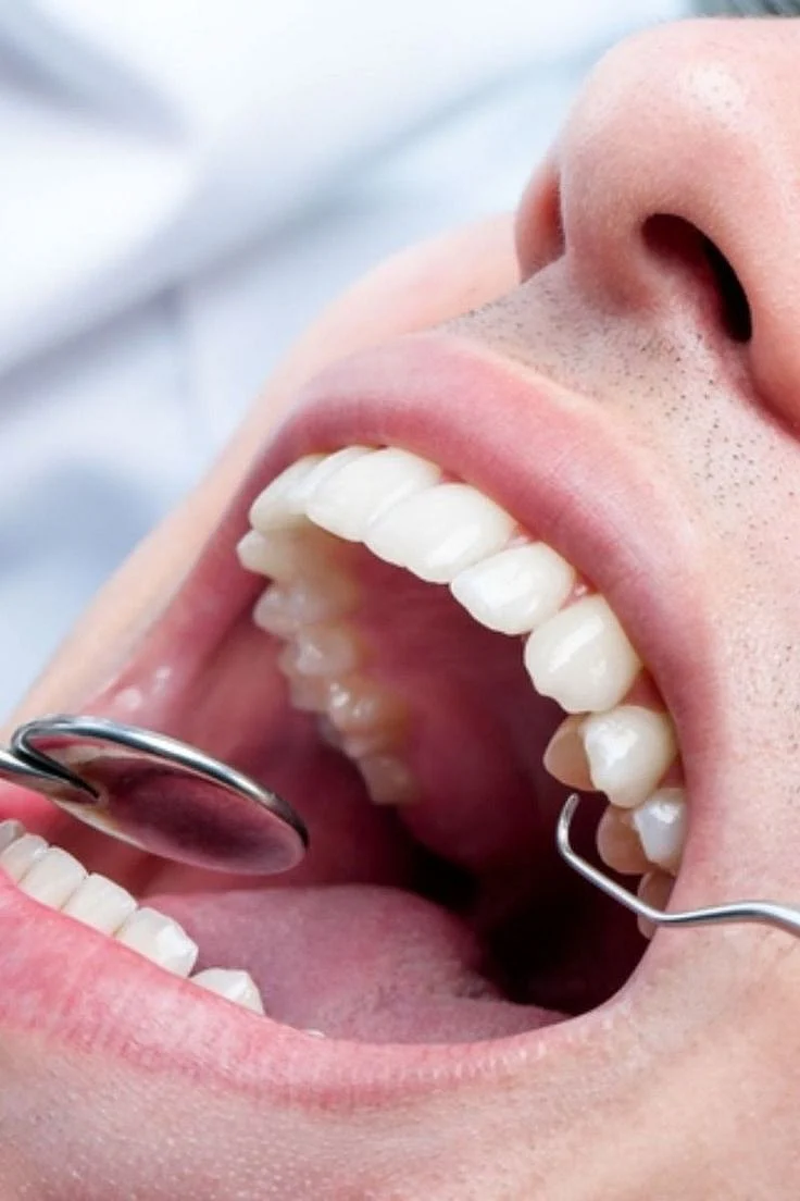 Consejos Efectivos para Prevenir el Sarro Dental en Tu Hogar