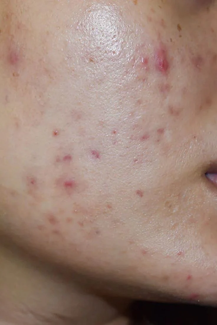 Post Inflammatory Erythema PIE Treating After Acne Red Spots