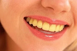Yellowness of teeth
