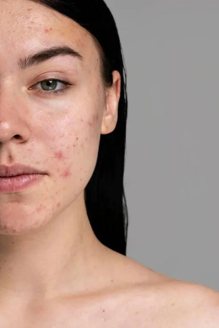 The Natural Way To Fade Acne Scars 1