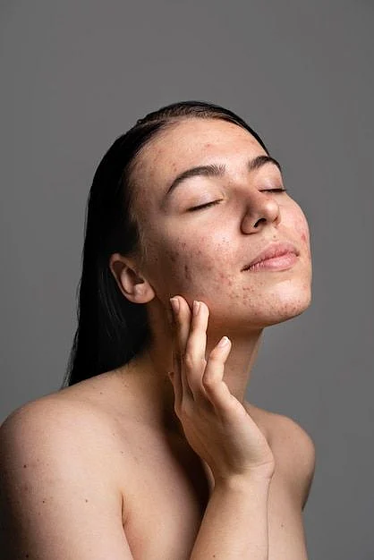 Free Photo Portrait of young woman being confident with acne