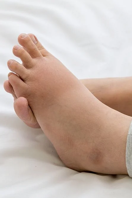 Causes of Water Retention
