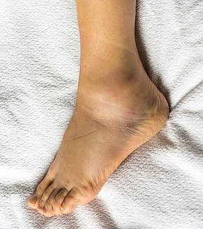 swollen feet