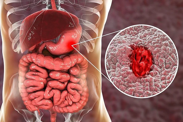 Visual Guide to Stomach Ulcers