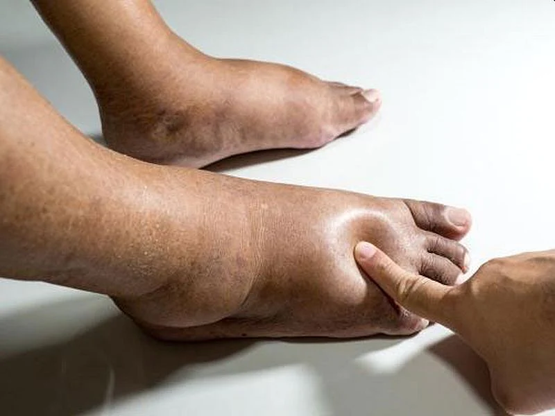 swelling home remedies202010185760