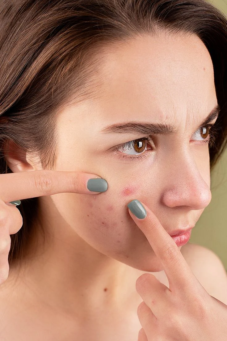 pimples