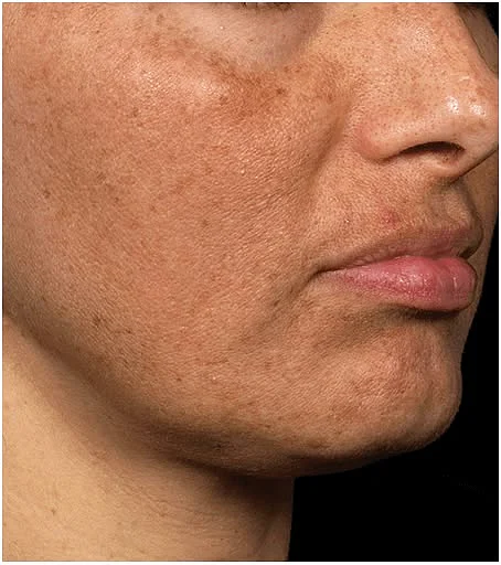 Skin Resurfacing Treatment