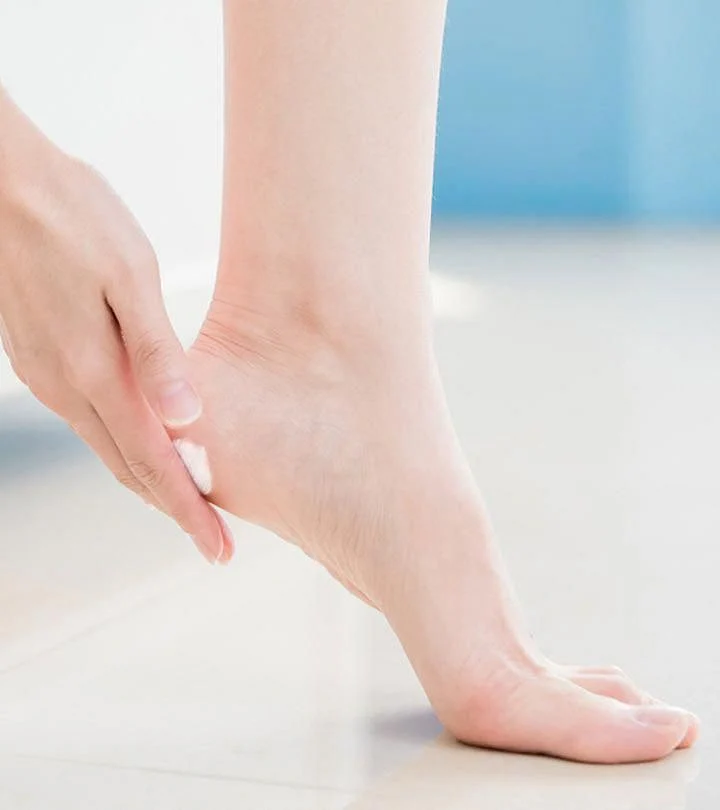 Cracked Heels