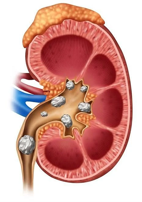kidney stone