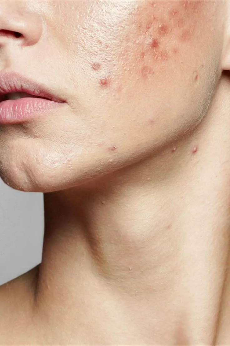 Dermatologists Share the Best Acne Advancements of the Last 5 Years