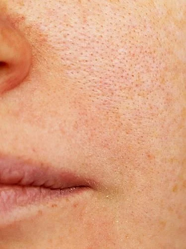 How to Get Rid of Pores on The Face Naturally The Top 7 Ways