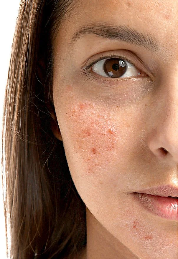 Pimples 5