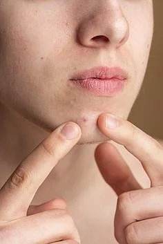 Pimples 6
