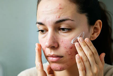 Pimples 7