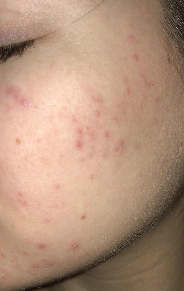 Pimples 3