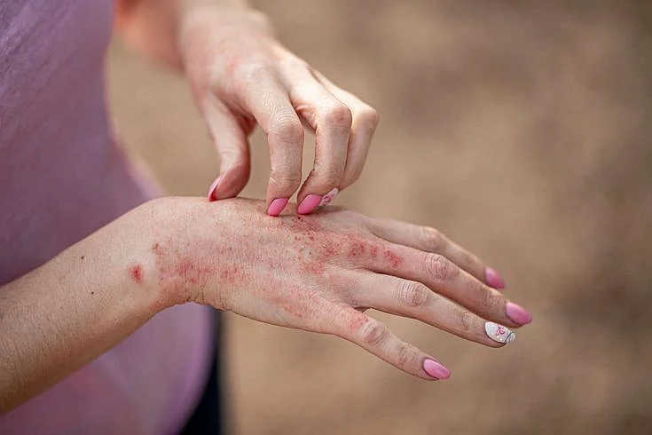 skin disease