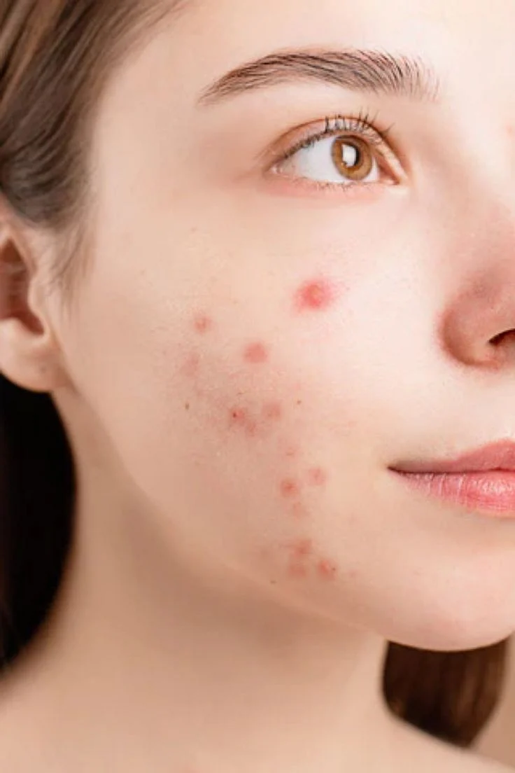 pimples9