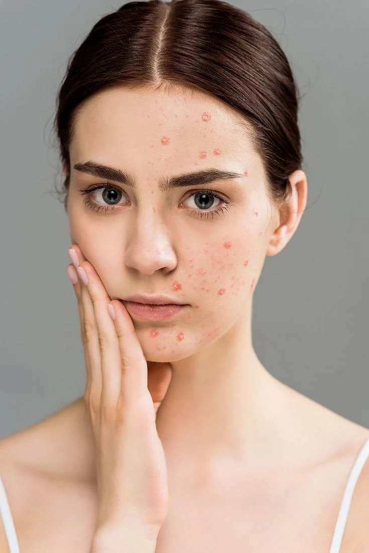 pimples