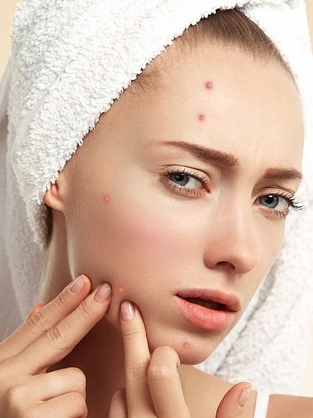 pimples.2