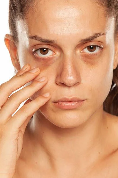 dark circles under the eyes