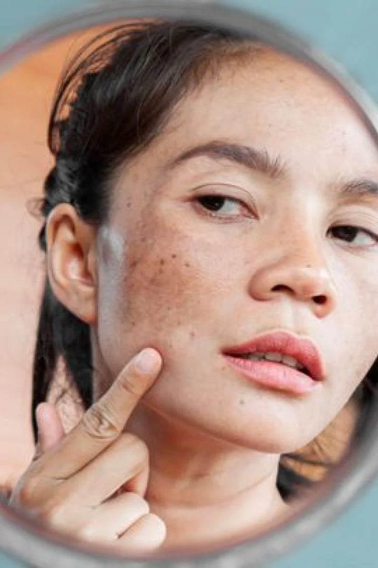 Hyperpigmentation