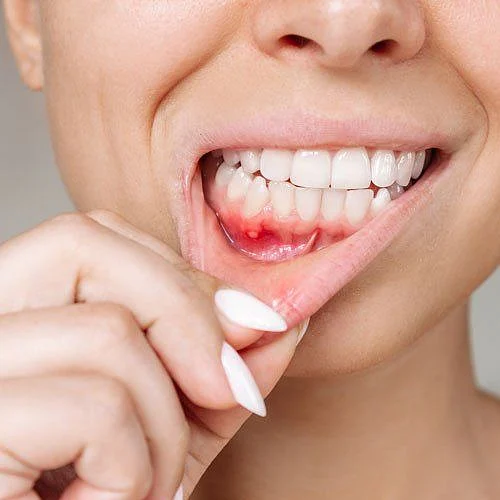 Mouth Ulcer Treatment Market Report 2025 2033