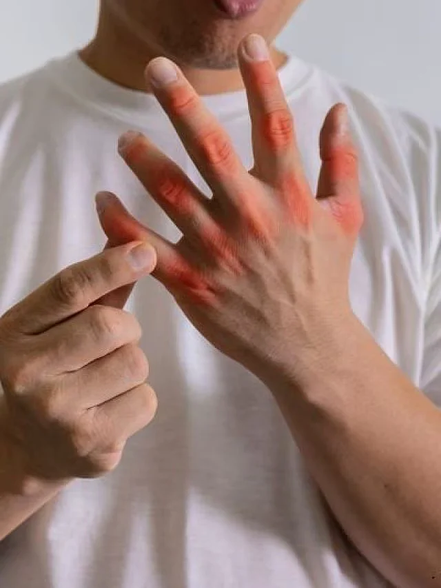 Uric Acid 1