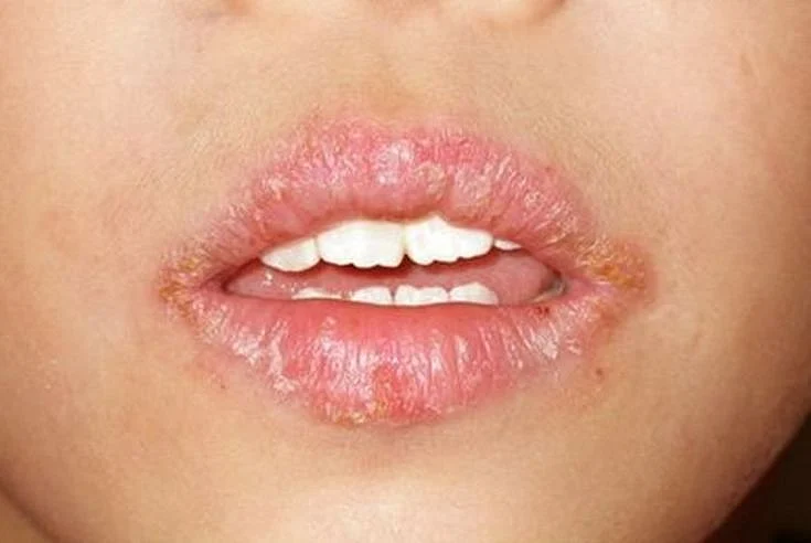 Angular Cheilitis Pictures Treatment Symptoms Causes