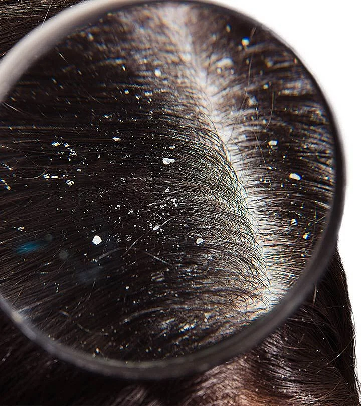 How To Treat Chronic Dandruff What Is It And Causes