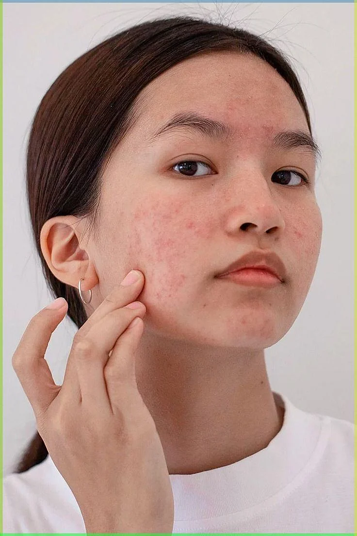 acne marks