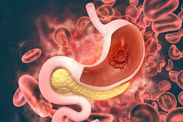 Peptic Ulcer Disease Symptoms A Comprehensive Guide