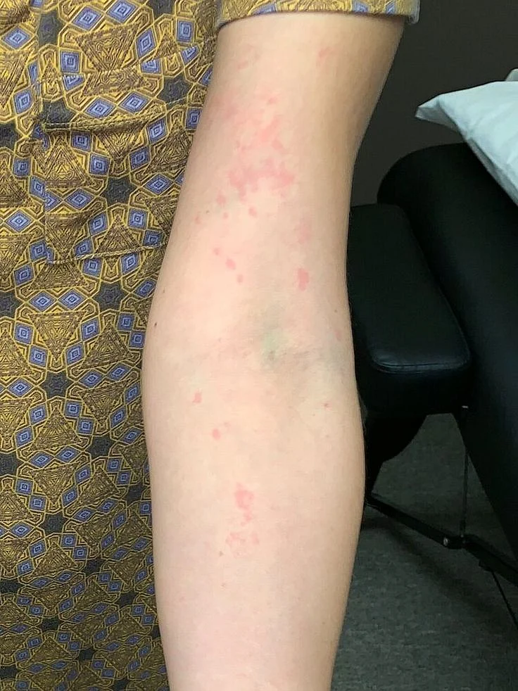 ACUPUNCTURE FOR SKIN CONDITIONS ECZEMA PSORIASIS URTICARIA HIVES DERMATITIS ITCH RASH
