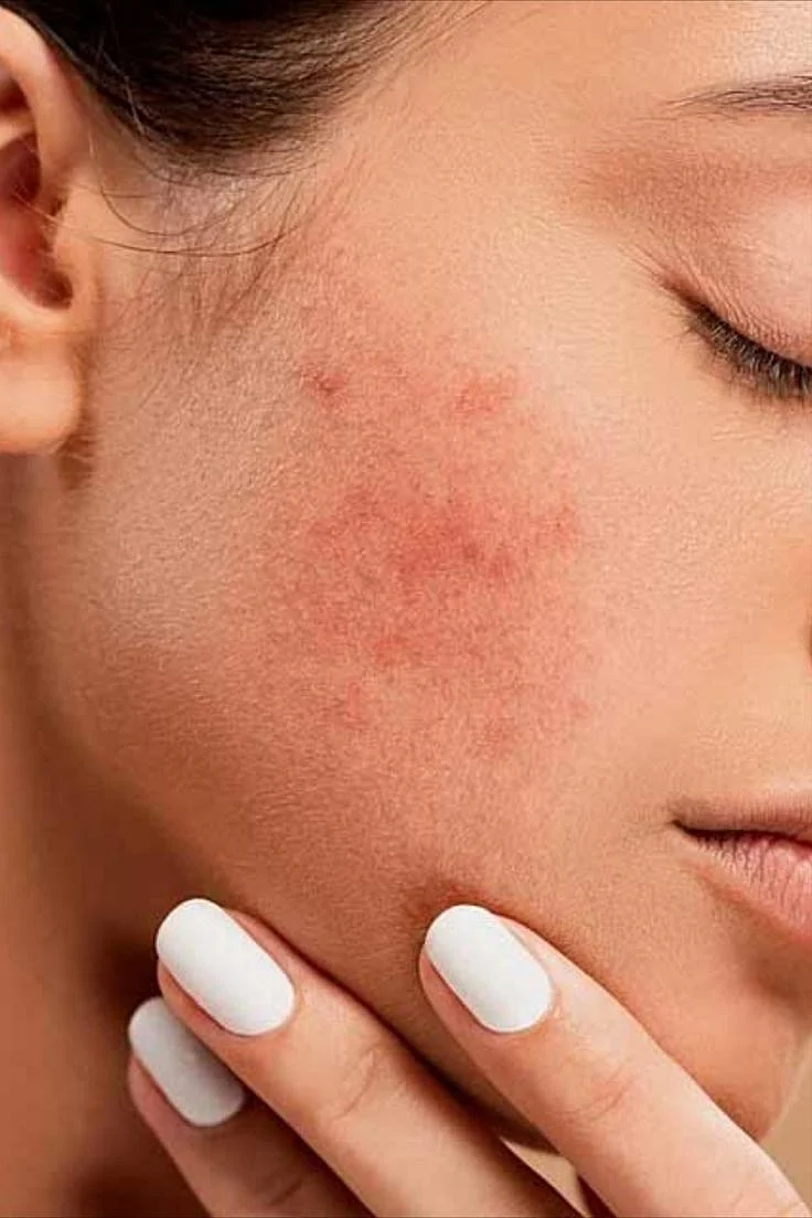 Skin Irritation 2