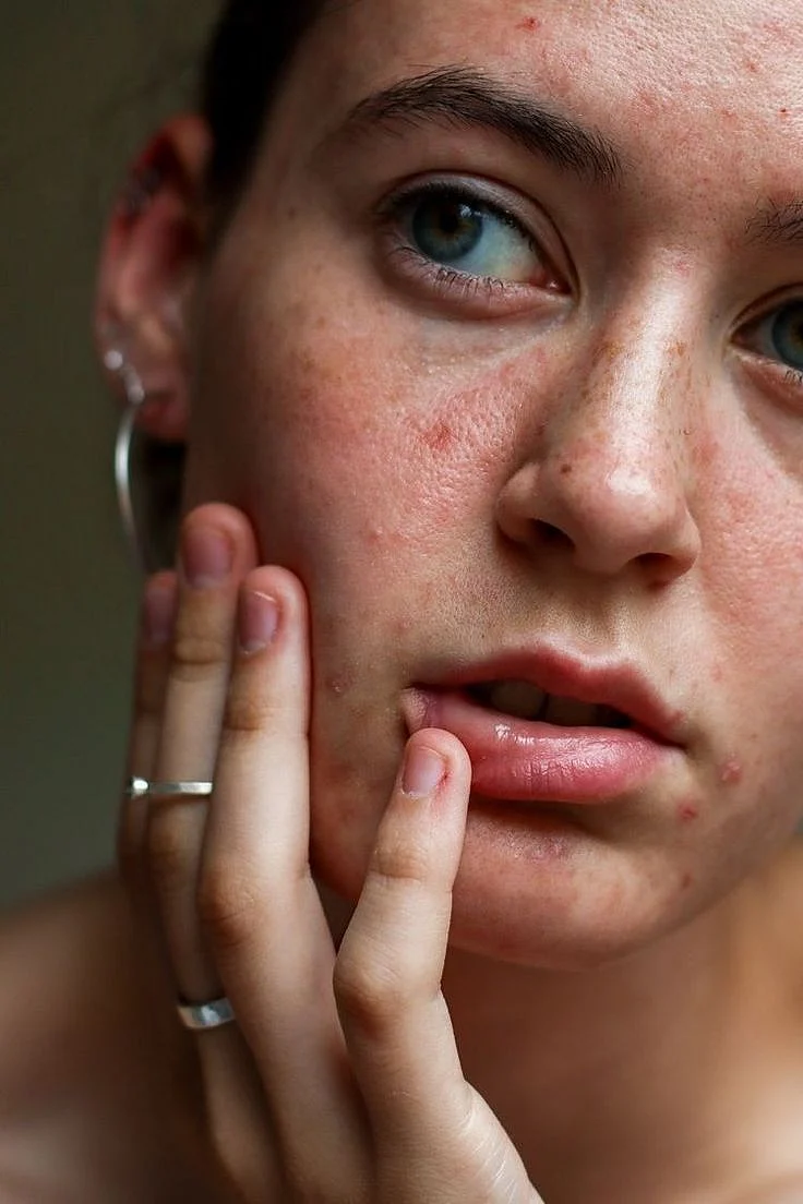 Skin Irritation 1