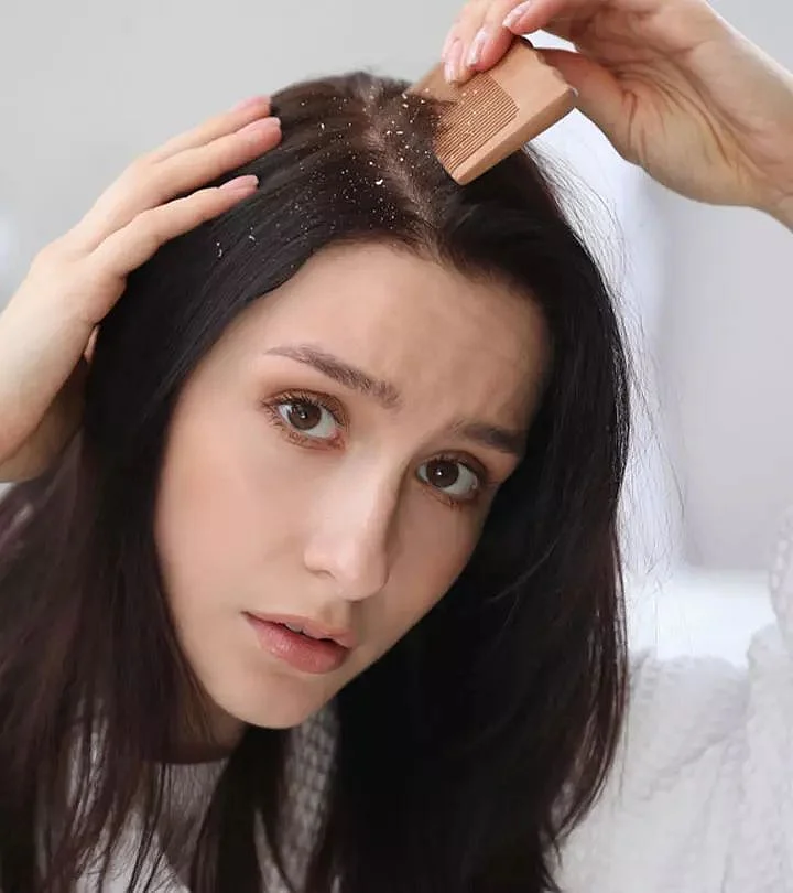 dandruff