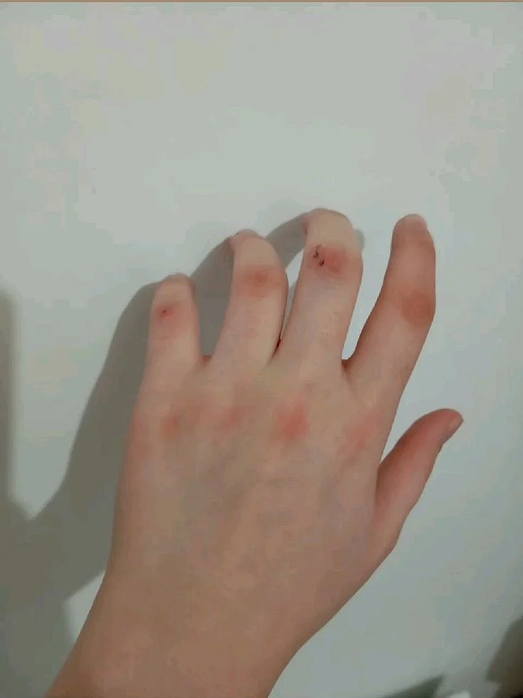 injury 2
