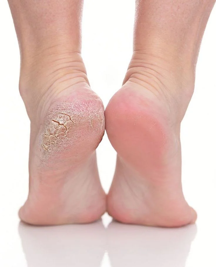 Cracked Heels