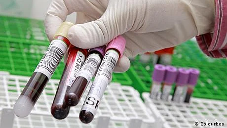 خون کے ٹیسٹ سے چھاتی کے سرطان کی تشخیص کا طریقہ